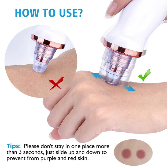 5 in 1 Blackhead remover | Derma Suction | Rechargeable
